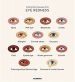 19 Red Eye Causes and How to Treat Red Eyes