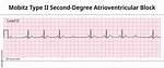 2Nd Degree Type 2