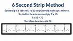 6 Second Ecg
