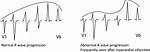 Abnormal R Wave Progression