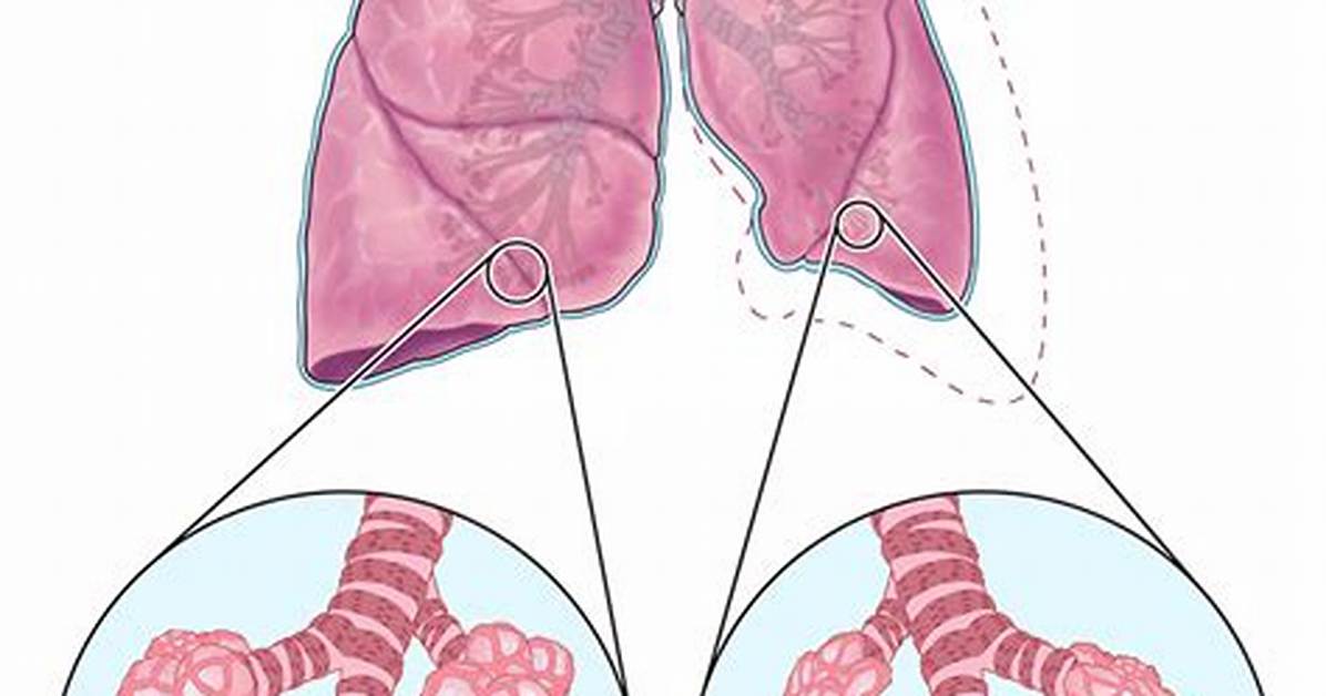 Absorption Atelectasis