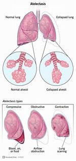 Absorption Atelectasis