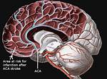 Aca Stroke