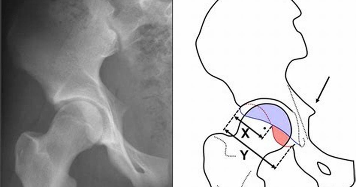 Acetabular Retroversion