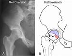 Acetabular Retroversion
