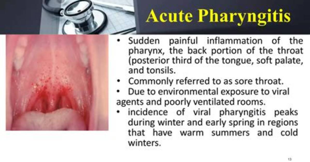 Acute Pharyngitis Unspecified