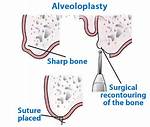 Alveoloplasty