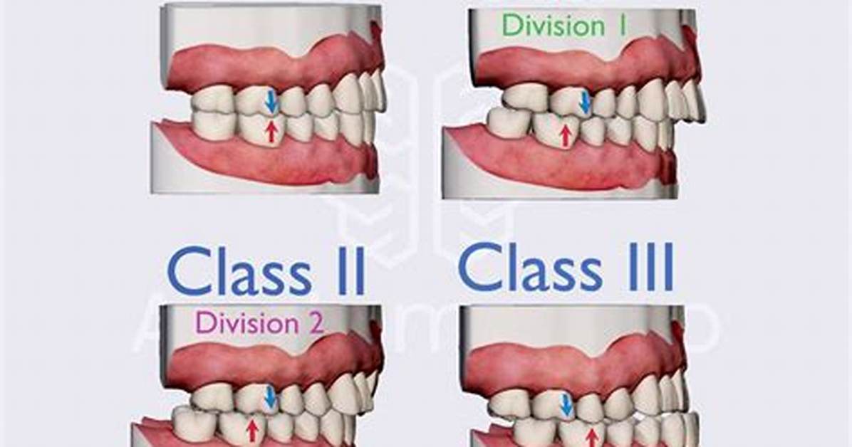 Angle Classification