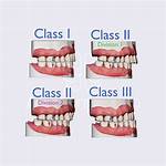 Angle Classification