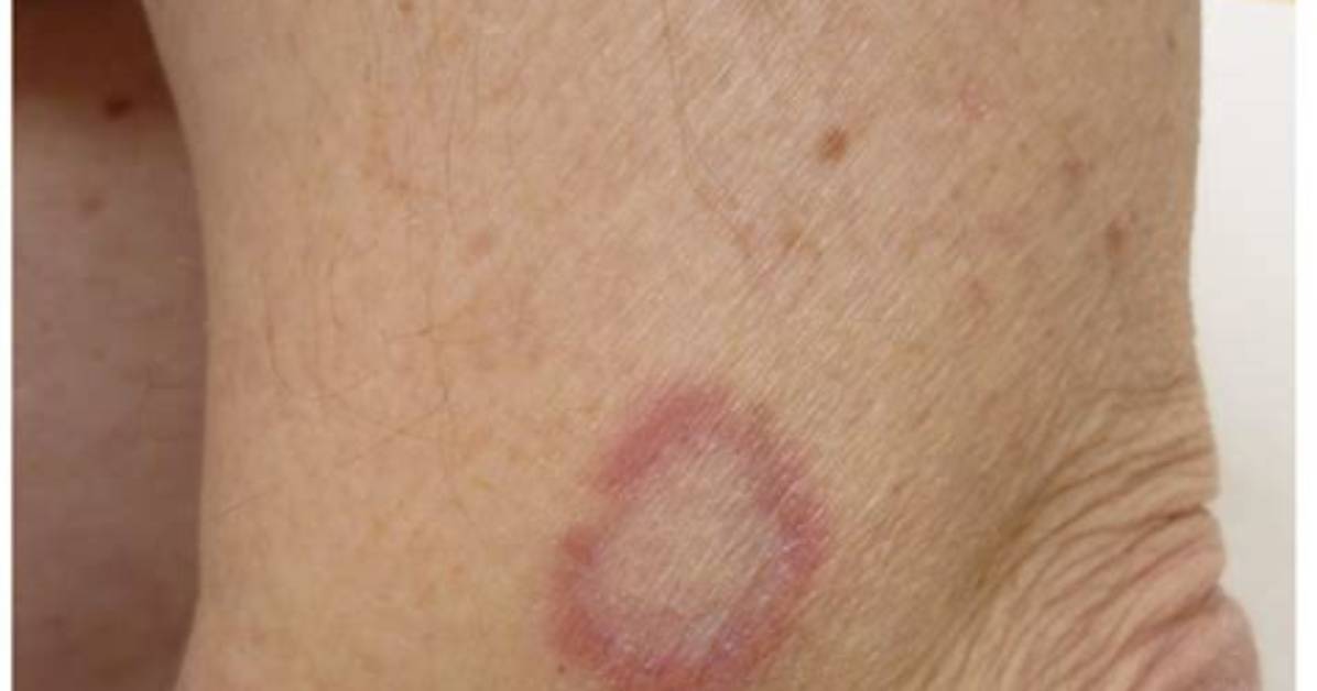 Annular Lesion