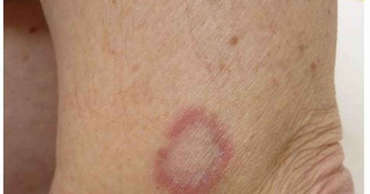 Annular Rash