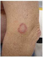 Annular Rash