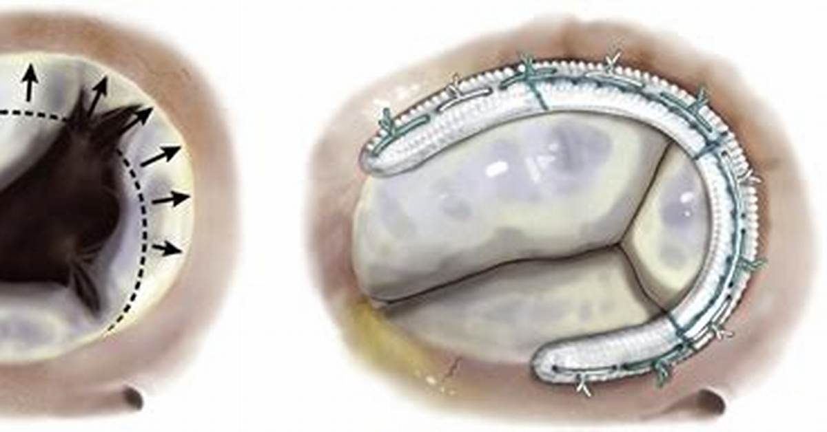 Annuloplasty Ring