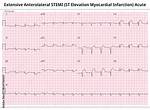 Anterolateral Infarct