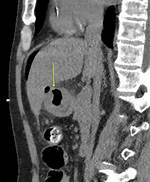 Antral Ulcer