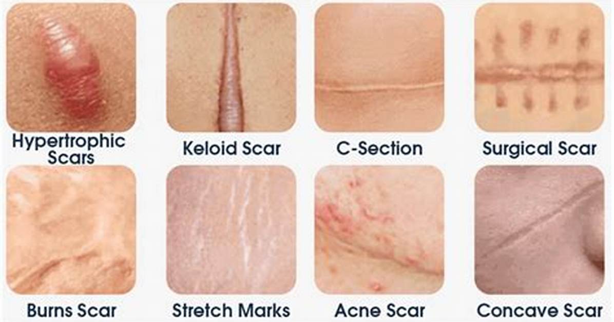 Are All Scars Permanent?