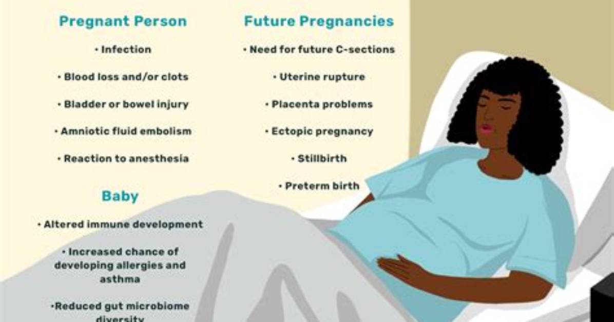 Are C Sections Bad?