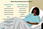 Are C Sections Bad?