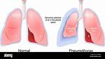 Are Collapsed Lungs Common?