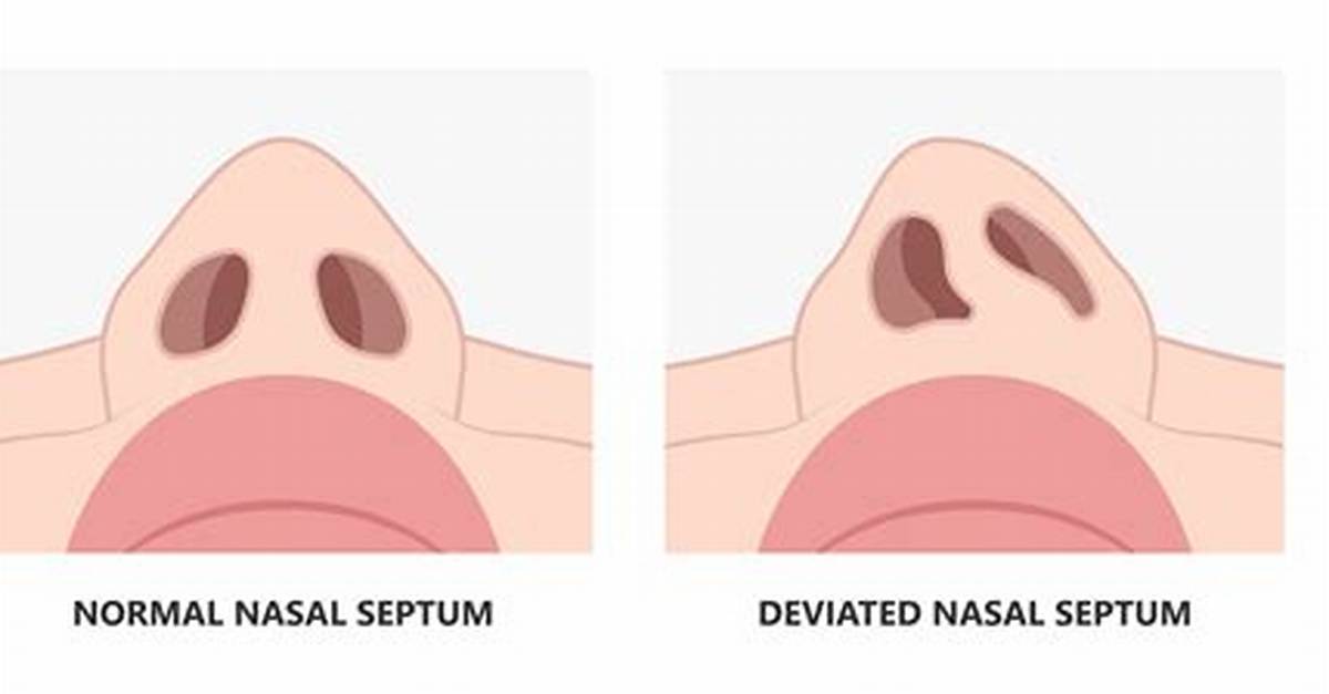 Are Deviated Septums Common?
