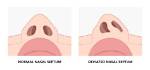 Are Deviated Septums Common?
