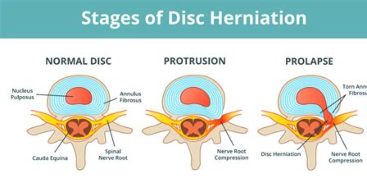 Are Disc Bulges Normal?