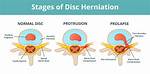 Are Disc Bulges Normal?