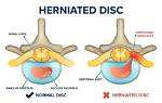 Are Disc Herniations Permanent?