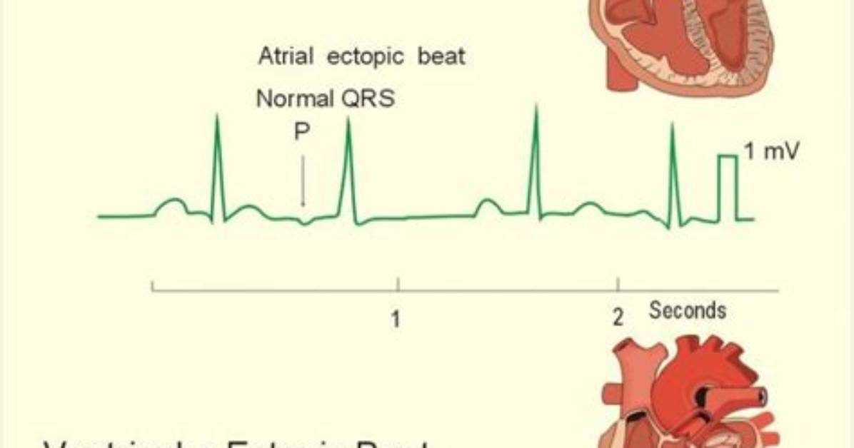 Are Ectopic Beats Normal?