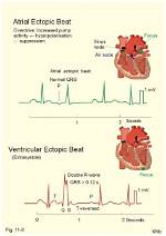 Are Ectopic Beats Normal?