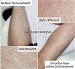Are Electrolysis Scars Permanent?