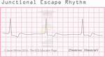 Are Junctional Escape Rhythms Lethal