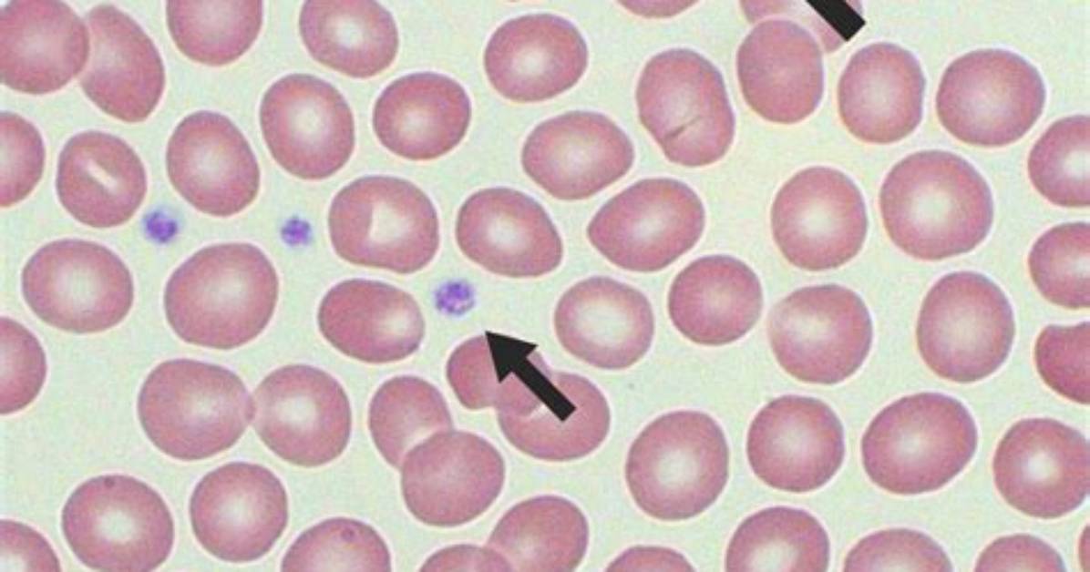 Are Large Platelets Bad