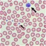 Are Large Platelets Bad