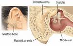 Are Mastoid Problems Hereditary?