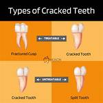 Are My Teeth Cracking?