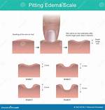 Are Pitting Edema Normal?
