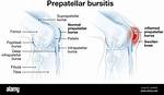 Are Prepatellar Bursitis Common?
