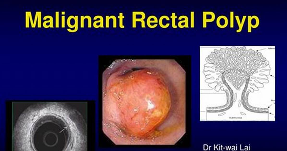Are Rectal Polyps Common?