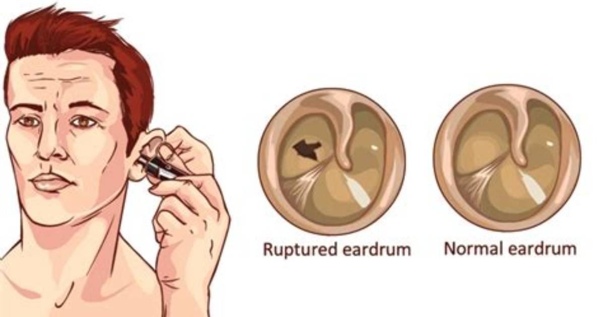 Are Ruptured Eardrum Permanent?