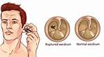 Are Ruptured Eardrum Permanent?