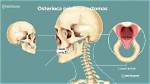 Are Skull Osteomas Common?