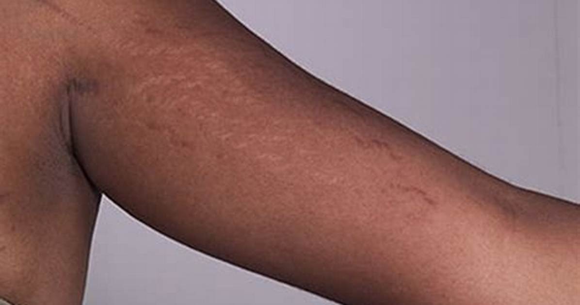 Arm Stretch Marks