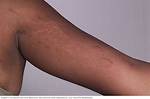 Arm Stretch Marks