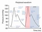 Arterial Waveform