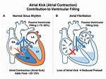 Atrial Kick