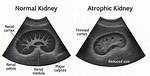 Atrophic Kidney