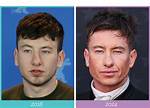 Barry Keoghan’s Plastic Surgery: Plastic Surgery for Jaw Reconstruction!