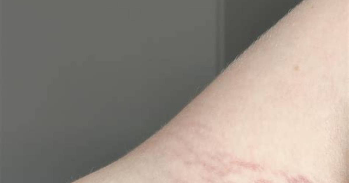 Bicep Stretch Marks