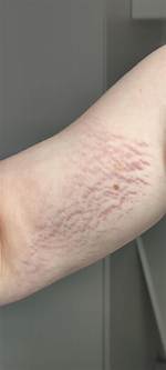 Bicep Stretch Marks